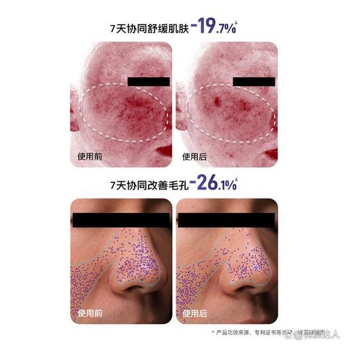 2026年美容儀品牌排行榜前10名 告別選擇困難，輕松選對優質美容儀